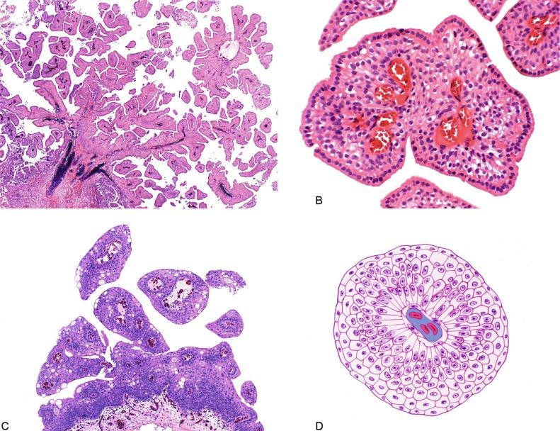 Fig. 6.1, Urothelial papilloma is a papillary lesion composed of delicate fibrovascular cores lined by cytologically and architecturally normal urothelium less than seven cell layers thick. (A) Low-power view of urothelial papilloma. (B) High-power view of the same tumor as in (A). (C) Another example of urothelial papilloma. (D) Schematic diagram of urothelial papilloma.