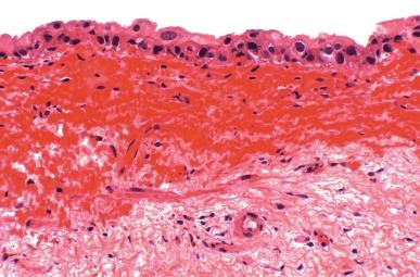 Fig. 6.11, Cyclophosphamide (Cytoxan)-induced changes include urothelial atypia and hemorrhagic cystitis.