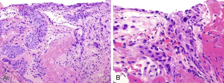 Fig. 6.12, Pseudocarcinomatous urothelial hyperplasia (A and B).