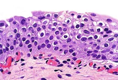 Fig. 6.13, Urothelial dysplasia.