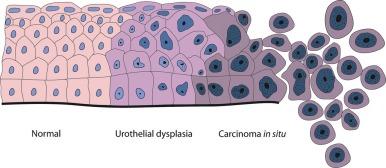 Fig. 6.14, Morphologic continuum from normal urothelium through dysplasia to carcinoma in situ and invasion. The dysplastic urothelium shows loss of orderly maturation and cellular polarity. The progression from dysplasia to carcinoma in situ is characterized by the increasing nuclear-to-cytoplasmic ratio, nuclear hyperchromasia, and nuclear and nucleolar enlargement. The superficial umbrella cell layer is often absent in urothelial carcinoma in situ, but its loss is not a prerequisite for the diagnosis. Urothelial carcinoma in situ often progresses to invasive cancer.