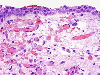 Fig. 6.15, Urothelial dysplasia.