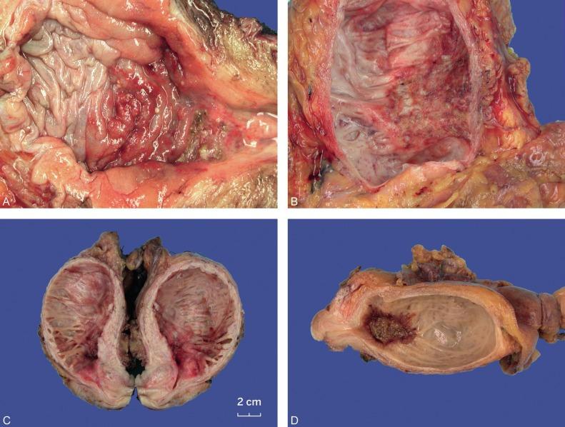 Fig. 6.16, Gross appearance of urothelial carcinoma in situ (A to D). Erythematous changes are common.