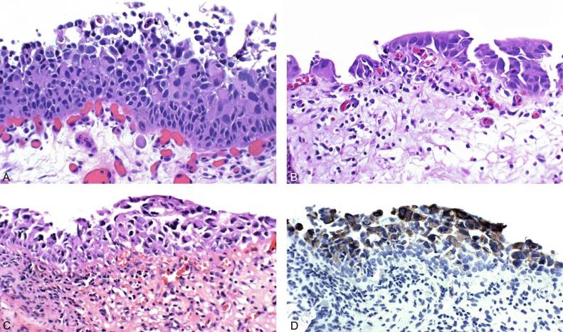 Fig. 6.18, Urothelial carcinoma in situ displaying disordered proliferation of malignant urothelial cells that demonstrate a high nuclear-to-cytoplasmic ratio, nuclear pleomorphism, irregular nuclear contours, coarsely granular chromatin, and prominent nucleoli. Loss of cellular polarity and cell cohesion are seen in urothelial carcinoma in situ (A to C). Vascular proliferation is often prominent in the underlying stroma. Full-thickness involvement is not required for the diagnosis of urothelial carcinoma in situ. The superficial umbrella cell layer may still be present. (D) Aberrant expression of cytokeratin 20 is observed.