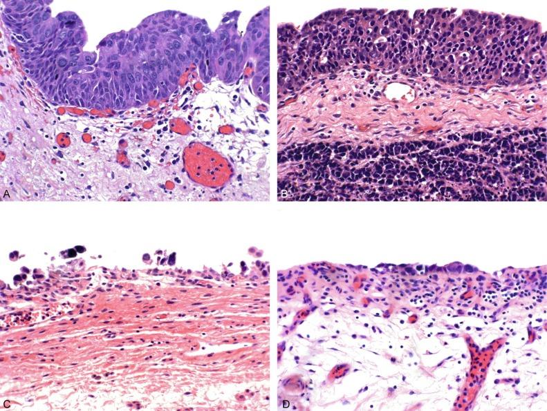 Fig. 6.19, Histologic variants of urothelial carcinoma in situ.