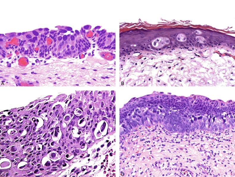 Fig. 6.20, Pagetoid and lepidic urothelial carcinoma in situ.