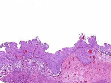 Fig. 6.2, Diffuse papillomatosis.