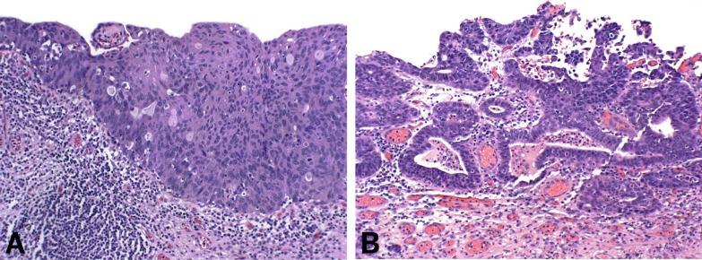 Fig. 6.21, Urothelial carcinoma in situ may show squamous (A) or glandular differentiation (B).