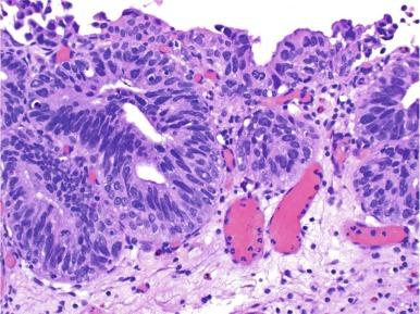 Fig. 6.22, Urothelial carcinoma in situ involving von Brunn nest may be misdiagnosed as adenocarcinoma in situ.