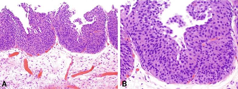 Fig. 6.23, Urothelial carcinoma in situ with micropapillary pattern (A and B).