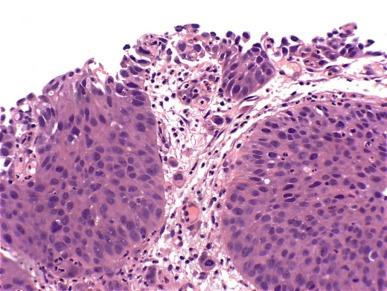 Fig. 6.24, Urothelial carcinoma in situ with microinvasion is characterized by individual single cells in the stroma. The adjacent von Brunn nests are also involved by carcinoma in situ.