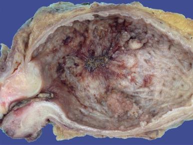 Fig. 6.26, Multifocal bladder cancer.