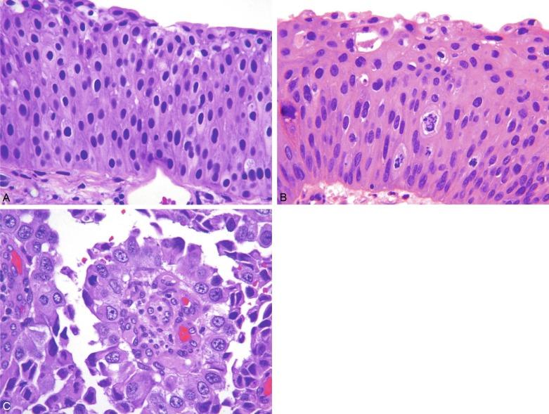 Fig. 6.28, Histologic grading of urothelial tumors using the 2004 World Health Organization (WHO) grading system.