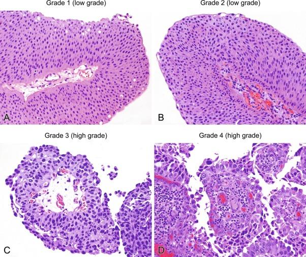 Fig. 6.30, Histologic grading of urothelial carcinoma, new proposal.