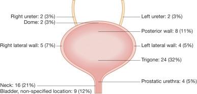 Fig. 6.3, Distribution of inverted papillomas in the urinary tract.