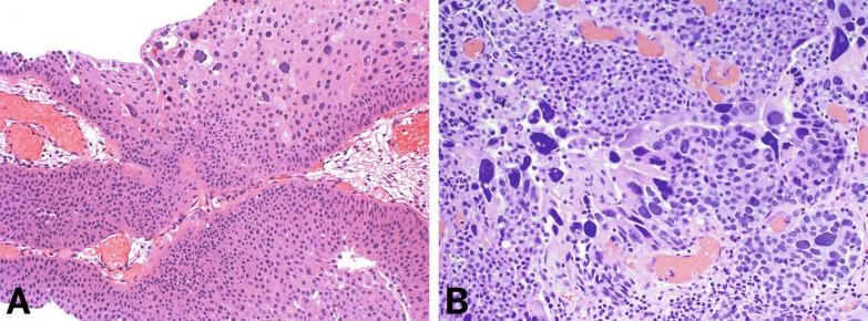 Fig. 6.31, Cancer heterogeneity of urothelial carcinoma (A and B). The same tumor may have areas with different histologic grades.