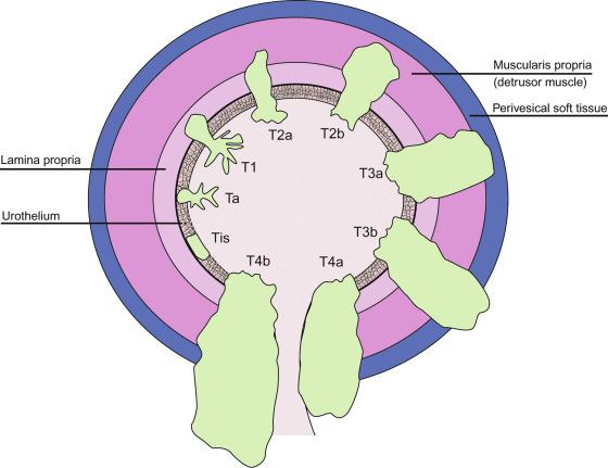 Fig. 6.33, Schematic diagram of staging of bladder carcinoma according to the 2016 tumor, lymph node, and metastasis (TNM) staging system.