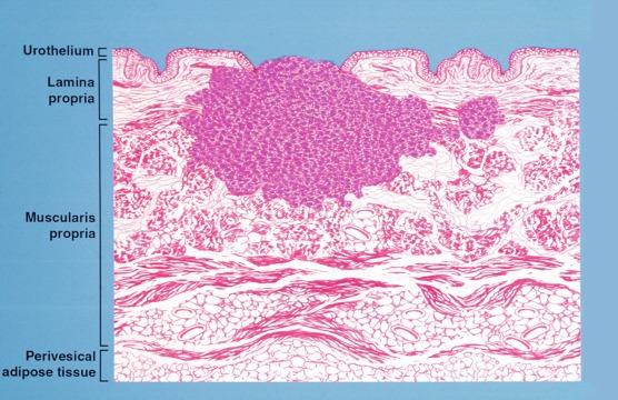 Fig. 6.34, The bladder is organized into the urothelium, lamina propria, muscularis propria, and perivesical adipose tissue. Adipose tissue can be present in the lamina propria or muscularis propria layer. Current staging system for bladder cancer is based on the depth of invasion. A tumor invading into muscular propria (detrusor muscle) is illustrated.