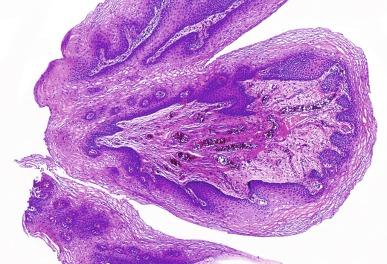 Fig. 6.5, Squamous cell papilloma of the urinary bladder.