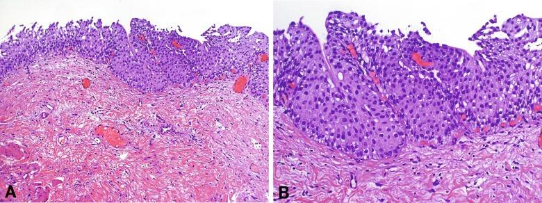 Fig. 6.6, Papillary urothelial hyperplasia (urothelial proliferation of uncertain malignant potential; A and B).