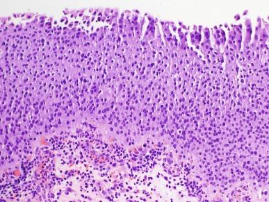 Fig. 6.8, Flat urothelial hyperplasia (urothelial proliferation of uncertain malignant potential).