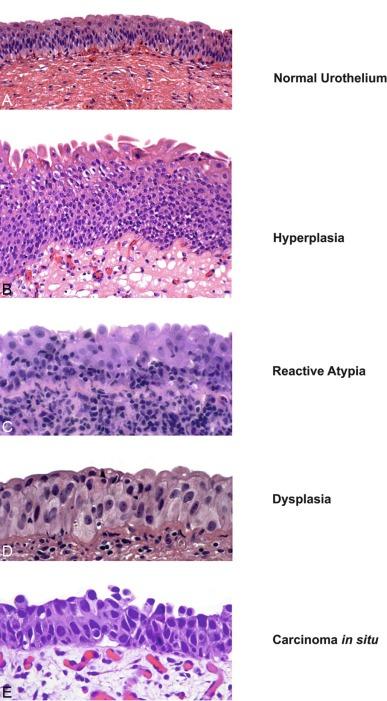 Fig. 6.9, Flat intraepithelial lesions.