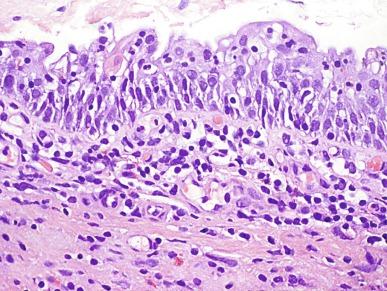 Fig. 6.10, Reactive urothelial atypia.