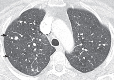 FIG 37-1, Diffuse idiopathic pulmonary neuroendocrine cell hyperplasia (DIPNECH) in a 63-year-old woman with a chronic history of progressive cough and dyspnea on minimal exertion, including laughing. CT scan shows multiple small bilateral pulmonary nodules (arrows). Wedge resection biopsy of the middle lobe revealed carcinoid tumor (5 mm) and multiple carcinoid tumorlets (<5 mm).