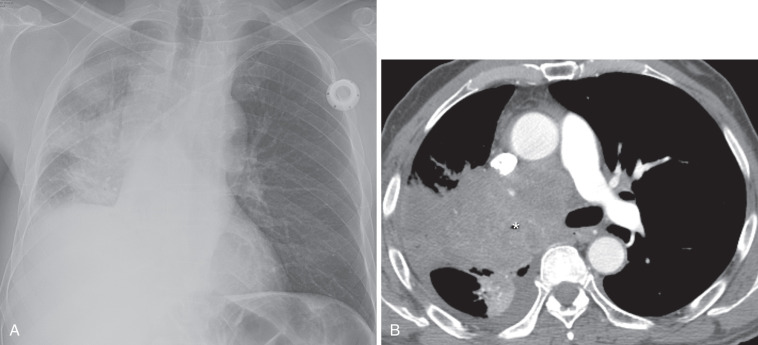 FIG 37-11, SCLC manifesting as extensive hilar and mediastinal adenopathy. A, Posteroanterior chest radiograph shows a large poorly marginated right mass, multicompartmental mediastinal adenopathy, and obstructive consolidation and atelectasis of the right lung. B, CT scan confirms marked hilar and mediastinal adenopathy and reveals marked narrowing of the bronchus intermedius (*). Note consolidative and atelectatic opacities distal to the large right hilar mass and a small right effusion.