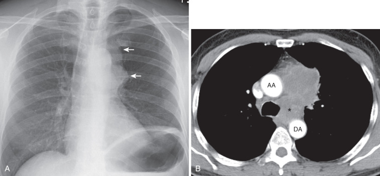 FIG 37-12, SCLC in a 65-year-old man presenting with hoarseness caused by involvement of the recurrent laryngeal nerve. A, Posteroanterior chest radiograph shows a left upper lobe mass extending to the perihilar region (arrows) and elevation of the left hemidiaphragm. Note diaphragmatic paralysis is due to phrenic nerve involvement. B, CT reveals mediastinal invasion with extension of the mass into the aortopulmonary window (*) (the anatomic location of recurrent laryngeal nerve). Note heterogeneous attenuation of the mass is consistent with necrosis. AA, ascending aorta; DA, descending aorta.