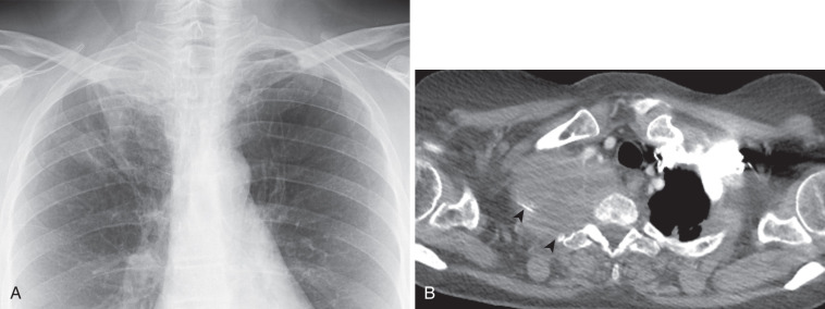 FIG 37-13, NSCLC in a 63-year-old woman with a superior sulcus (Pancoast) tumor and a history of shoulder pain. A, Posteroanterior chest radiograph shows a poorly marginated right apical mass. B, CT 6 months after A confirms the superior sulcus tumor and shows destruction of the first and second ribs (arrowheads).