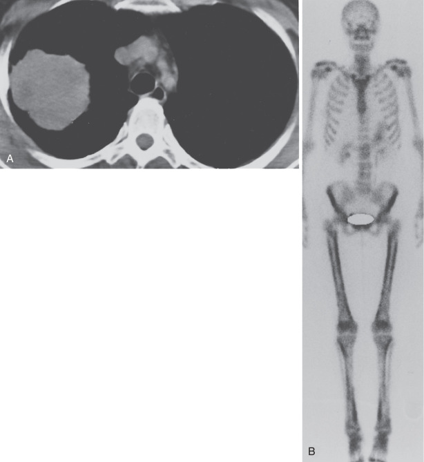 FIG 37-14, NSCLC in an asymptomatic 64-year-old woman. A, CT scan shows a large right upper lobe mass. B, Technetium 99m ( 99m Tc)-labeled methylene diphosphonate (MDP) bone scintigraphy shows linear areas of increased radiotracer uptake in the femurs and tibias. This appearance is characteristic of hypertrophic pulmonary osteoarthropathy.