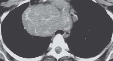 FIG 37-15, NSCLC manifesting as a calcified mass. CT shows a large right upper lobe mass with mediastinal invasion. Scattered areas of amorphous calcification in the mass are typical of (but not diagnostic for) malignancy.