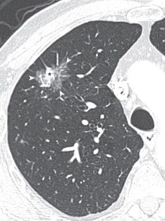 FIG 37-16, Adenocarcinoma manifesting as a part ground-glass and solid nodule. CT shows a nodule with ground-glass and solid tissue (*) attenuation (arrowheads). Part-solid nodular opacities have the highest incidence of malignancy when compared to pure ground-glass opacities and solid nodules.