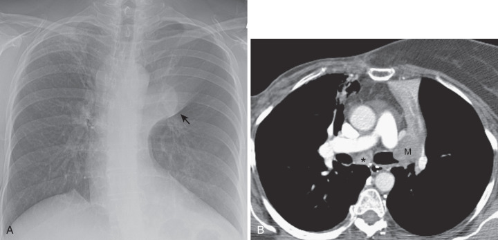 FIG 37-2, Squamous cell lung cancer manifesting as a central endobronchial mass. A, Posteroanterior chest radiograph shows complete atelectasis of the left upper lobe. Convexity in the lower portion of the atelectatic lung (arrow) is the result of a central mass. B, CT confirms an endobronchial mass (M) that occludes the left upper lobe bronchus and causes complete atelectasis of the left upper lobe. Note the enlarged subcarinal node (*) due to metastasis.