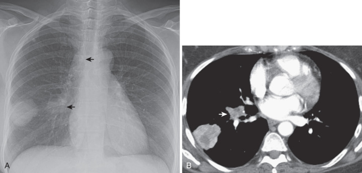 FIG 37-3, Squamous cell lung cancer manifesting as a peripheral mass. A, Posteroanterior chest radiograph shows a mass in the right lower lobe and infrahilar and paratracheal adenopathy (arrows). B, CT confirms the mass in the right lower lobe and infrahilar adenopathy (arrow) and reveals variable attenuation of the mass consistent with necrosis.