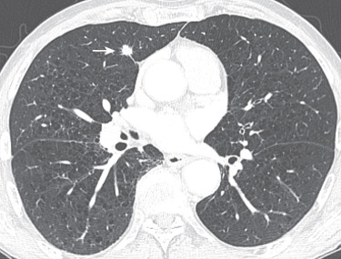 FIG 37-4, Adenocarcinoma manifesting as a pulmonary nodule. CT scan shows a solid nodule in the right upper lobe (arrow). The spiculated margin is typical of lung cancer. Note acinar, papillary, micropapillary, or solid-predominant patterns and invasive mucinous adenocarcinomas manifest as solid nodules.