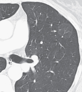 FIG 37-5, Adenocarcinoma manifesting as a pulmonary nodule with ground-glass attenuation. CT scan shows a well-marginated ground-glass opacity in the left upper lobe (arrow). Surgical clips are present because of prior left lower lobe lobectomy. Note nonmucinous minimally invasive and lepidic-predominant nonmucinous adenocarcinomas typically manifest as solitary ground-glass or part-solid nodules.