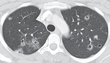 FIG 37-6, Adenocarcinoma manifesting as multiple pulmonary nodules. CT shows small pulmonary nodules and ground-glass opacities. Cavitary nodules with central areas of cavitation are occasionally referred to as the Cheerio sign.