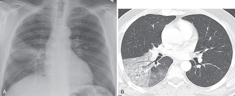 FIG 37-7, Adenocarcinoma mimicking pneumonia. A, Posteroanterior chest radiograph shows poorly marginated homogeneous consolidative opacity in the right lower lobe. B, CT confirms right lower lobe consolidation and reveals ground-glass opacities in the right lower lobe. Note invasive mucinous adenocarcinoma can manifest as consolidative opacities and are frequently multifocal.