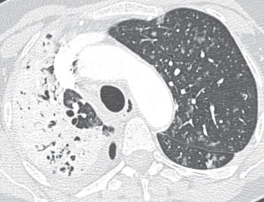 FIG 37-8, Adenocarcinoma manifesting as nodules and consolidation. CT scan shows an opacity in the right upper lobe resembling pneumonia and numerous small solid and ground-glass nodules in the right lung.