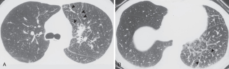 FIG 37-9, Adenocarcinoma of the lung manifesting as lymphangitic carcinomatosis. A and B, Thin-section CT scan shows thickening of bronchial walls and interlobular septa (arrowheads) in the left lung. Nodularity of the septa is suggestive of malignancy.