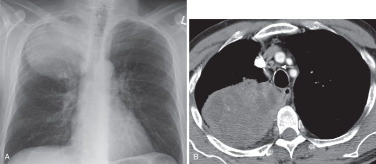 FIG 37-10, Large cell lung cancer manifesting as a large mass. A, Posteroanterior chest radiograph shows a large mass in the right upper lobe. B, CT shows a well-circumscribed mass. Note heterogeneous attenuation of the mass is consistent with necrosis and nonenlarged paratracheal lymph nodes (arrow).