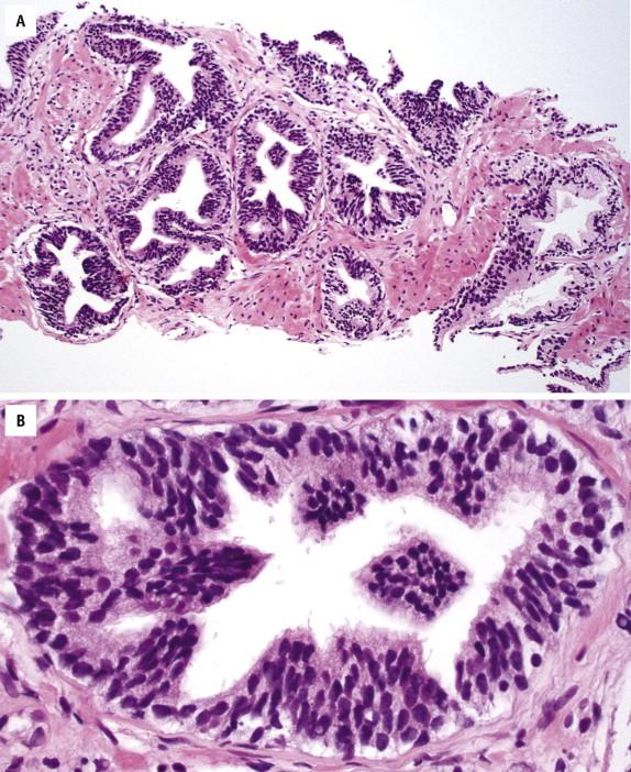 FIGURE 2-1, A, At low magnification, low-grade prostatic intraepithelial neoplasia glands (left) have an architecture similar to normal glands (right), but they appear darker than the latter. Secretory cells show focal nuclear crowding and stratification. Nuclei are enlarged with size variation; however, there are no conspicuous nucleoli ( B ).