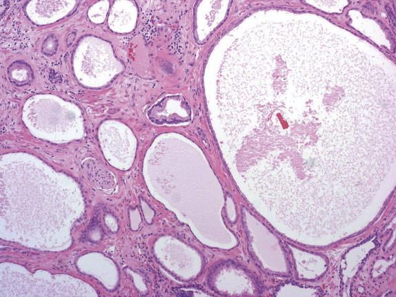 FIGURE 2-11, At low magnification, microcystic adenocarcinoma is characterized by cystically dilated glands with a flat luminal lining. Intraluminal crystalloids are commonly seen.