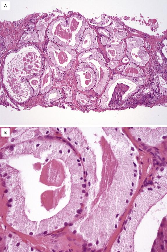 FIGURE 2-12, In foamy gland carcinoma, cancer glands frequently have intraluminal, dense, pink, acellular secretions and abundant foamy cytoplasm ( A ). The nuclei are typically small and hyperchromatic ( B ).