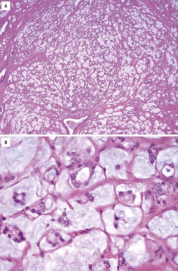 FIGURE 2-13, In mucinous prostate carcinoma, cancer cells float in lakes of extracellular mucin ( A ) and are arranged in cords and acini. Cytologically, they appear bland with occasional prominent nucleoli ( B ).