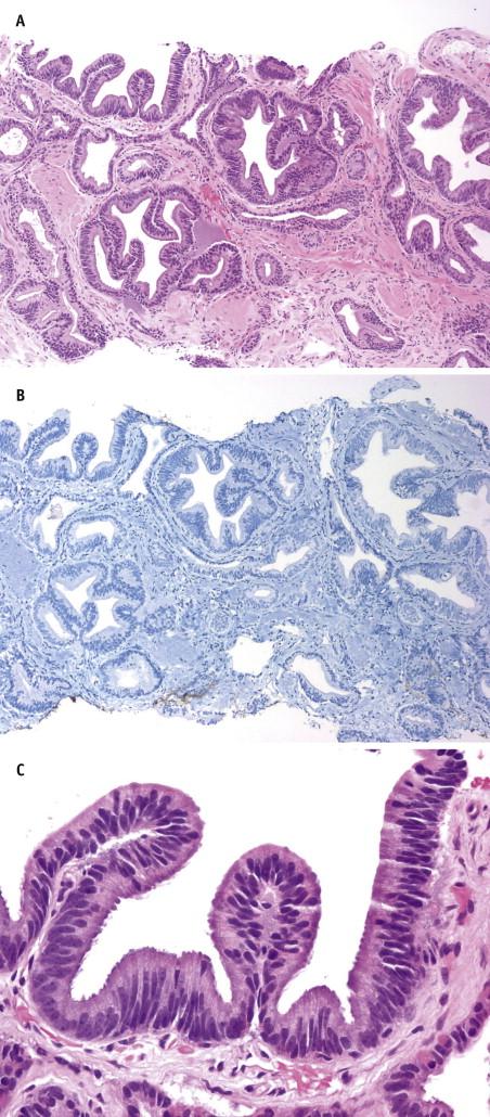 FIGURE 2-14, The glands of prostatic intraepithelial neoplasia (PIN)–like adenocarcinoma are characterized by noncribriform stratified epithelium similar to flat, tufted, or micropapillary patterns of PIN ( A ). p63 immunostains for basal cells are completely negative ( B ). At high magnification, some cases may display high columnar cells that resemble ductal adenocarcinoma (PIN-like ductal adenocarcinoma; C ).