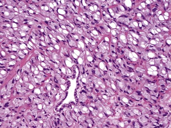 FIGURE 2-15, Signet-ring–like cancer cells display nuclear displacement and indentation with clear cytoplasmic vacuoles.