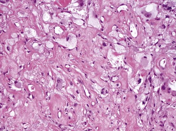 FIGURE 2-19, After radiation therapy, cancer glands become poorly formed, with single cells infiltrating in the fibrotic stroma. They have abundant vacuolated cytoplasm and pyknotic nuclei.